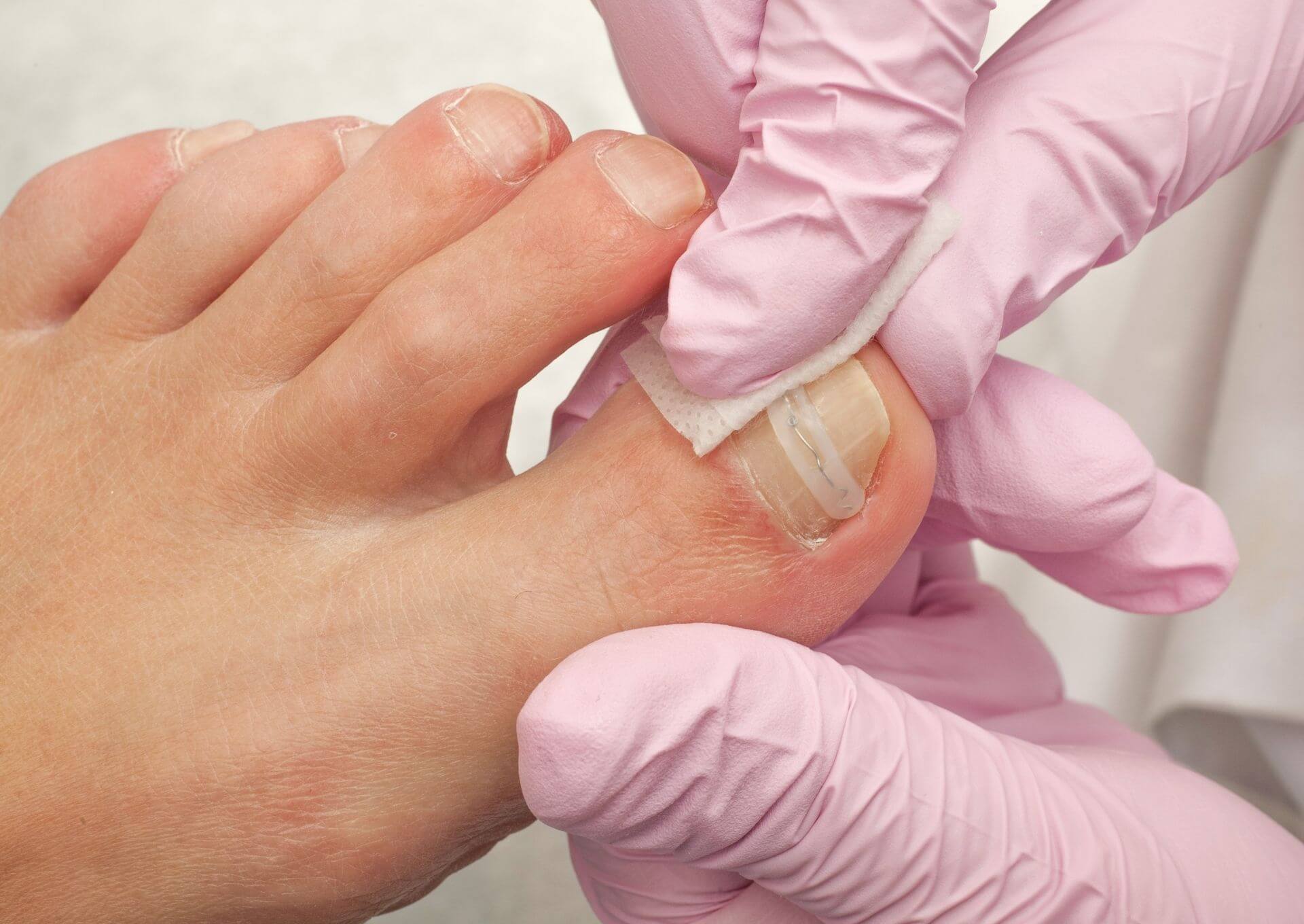 Zabieg terapii paznokci pogrubionych
