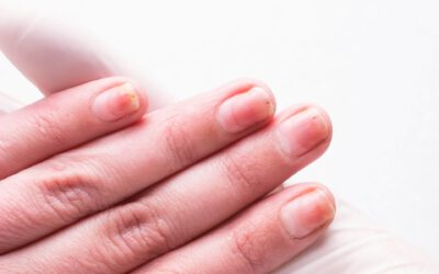Onycholiza — co to jest, jak się objawia na paznokciu i jak leczyć?